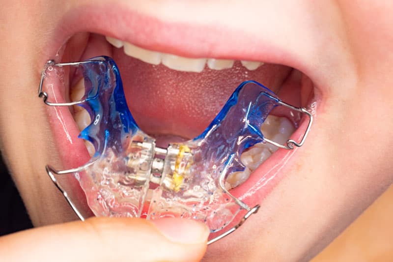 Ortodoncia removible